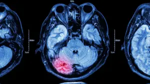 September is World Alzheimer’s Month, a time to raise awareness about Alzheimer’s disease and other forms of dementia and the factors that may influence long-term brain health. One important area of research involves traumatic brain injuries (TBIs). Traumatic Brain Injuries and Dementia: What’s the Connection?