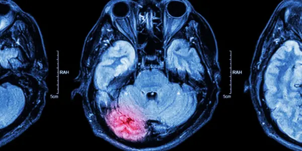 Traumatic Brain Injuries and Dementia: What’s the Connection?